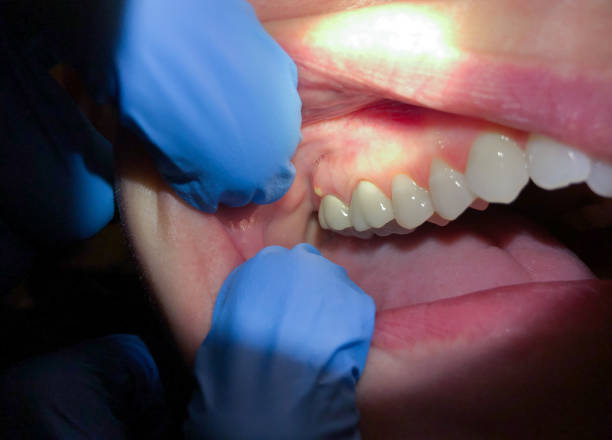 Best Emergency Dentist for Knocked-Out Tooth in Shanor Northvue, PA
